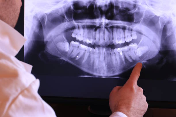 Best Emergency Wisdom Teeth Removal in Shpee Neck, MA